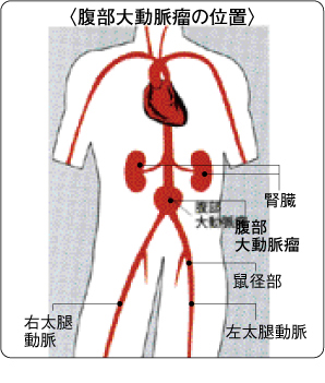 腹部大動脈